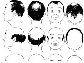 在南陽，選擇種植頭發價格怎么說？