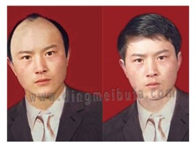 怎樣治療脫發？男士治療脫發小秘方